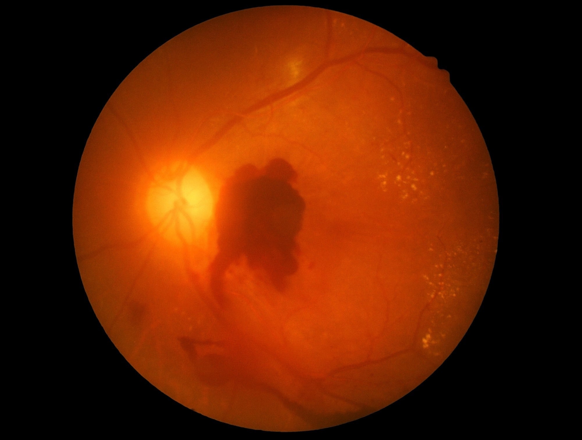 Semaglutide linked to higher risk of vision problems, FDA data analysis shows
