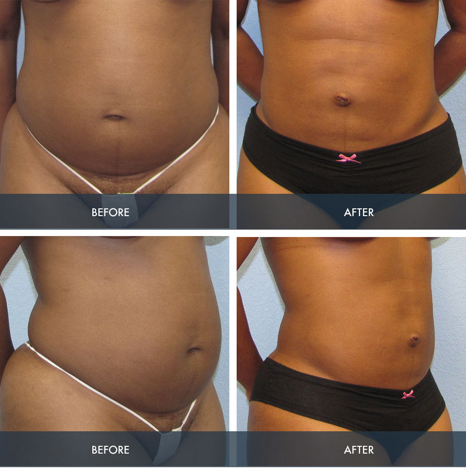 lipo c injection before and after stomach Liposuction Gallery in Houston & Pearland, TX Liposuction Before and After
